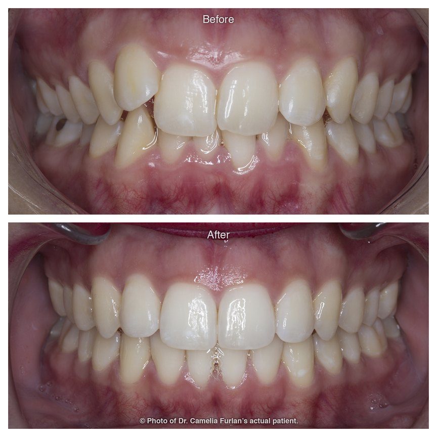 Misaligned Teeth Fixed With Orthodontics