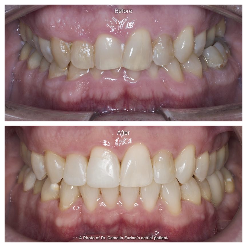 Stained and wonky teeth smile makeover