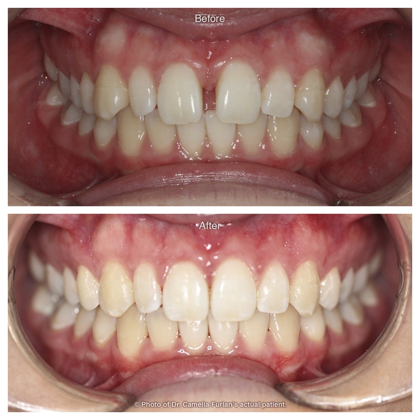 Gap in top teeth closed up with braces